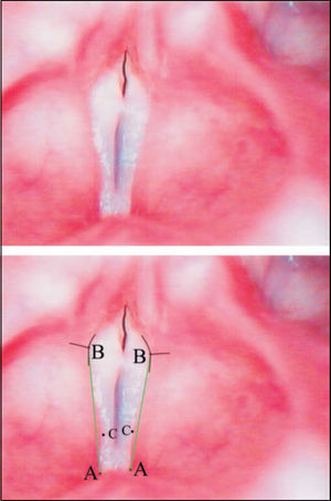 Superior – Laryngeal telelaryngoscopic image in male gender during emission of vowel/e/with major stria sulcus and Convex vestibular fold. Inferior – same image of points, definition insertion lines of points B (black) and straight reference lines AB (green).