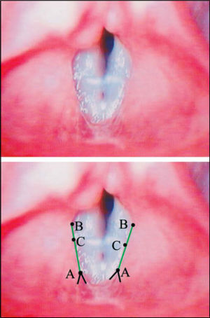 Superior – Laryngeal telelaryngoscopic image in female gender during emission of vowel/e/with vocal nodule and linear vestibular folds. Inferior – same image of points (black), definition lines of points (black) and straight reference lines (green).