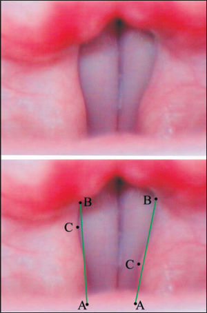 Superior – Laryngeal telelaryngoscopic image of male gender during emission of vowel/e/, normal voice, with sinusoid vestibular folds, right one Concave and left one Convex. Inferior – same image of points and reference arrows AB.
