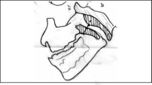 Scheme illustrating Cohen & Konak method, which compares the soft palate thickness (one centimeter below the hard palate or half centimeter in children younger 3 years old) presenting the air column between this spot in the palate and the highest convexity spot of adenoid (blue line). In the present example, it is a large adenoid.