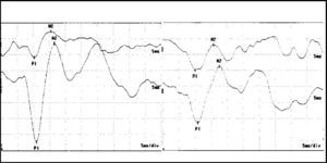 Waves P1 and N2 latency at VEMP in control group subjects. Chart on the right = right ear; chart on the left = left ear.