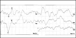 Waves P1 and N2 latency at VEMP in case 1 of the EM group. Absence of response on the right. Chart on the right = right ear; chart on the left = left ear.