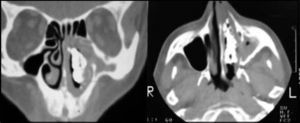 Coronal and axial CT scan sections showing large rhinolith in the left nasal fossa.