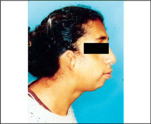 Clinical signs of Treacher Collins' syndrome (profile).