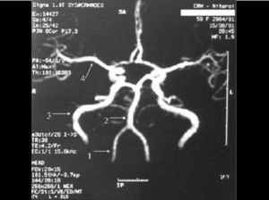 Normal anatomy of arteries: 1 – vertebral; 2 – basilar; 3 – internal carotid; 4 – media cerebral artery.
