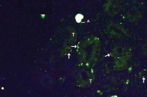 Example of labeling grade 3. Numerous fibers (arrows). Tissue auto-fluorescence (T) and artifacts (A).