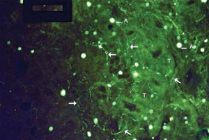 Examples of labeling grade 4. Many fibers (arrows), and it is possible to follow their pathway intertwined with glandular structures. More marked tissue auto-fluorescence (T) and artifacts (A).