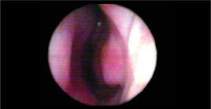 Photography of nasal valve after nasal topical vasoconstrictor.