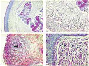 Microscopic characterization of vestibular fold lesions. Normal vestibular fold (A) with discreet diffuse mononuclear infiltrate or absence of inflammatory cells on lamina propria. Vestibular folds with intense mononuclear inflammatory infiltrate on lamina propria (B) and follicle hyperplasia (C, arrow). The presence of neutrophils in the inflammatory infiltrate (D, arrow) was considered as acute inflammatory reaction (PAS, 320X).