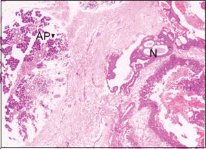 Infiltrative glandular epithelial aspect of neoplasm (N). AP: parotid acines. (HE, objective 4X).
