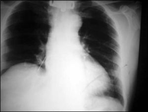 Chest X-ray in PA showing foreign body in right source bronchus.