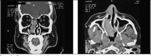 Two CT scan sections of patient J.C. showing lesion of soft part density on the right nasal cavity.