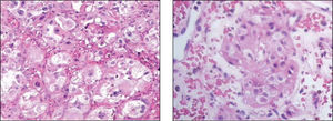 Histological sections of nasal paraganglioma showing epithelioid cells that form nests named zellballen, separated by a network of capillaries stained with HE with 50X and 100X.