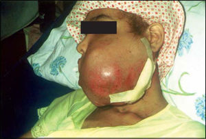 Extraoral clinical aspect of recurring tumor 8 months after surgery.