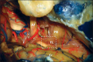 Further magnification showing the depression that exists between the acoustic-facial bundle (AF) and bulb pairs (PB) (white square). This depression corresponds to Luschka's foramen (FL) and it is easily visible after moving away the cerebellum flocculus (BJ: jugular bulb, CSC: semicircular canals, Cr: cerebellum).
