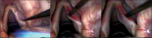 Incision made on the upper surface of the vocal fold and subepithelial detachment.