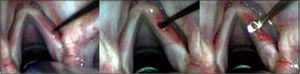 Incision on the upper surface of the vocal fold, 2 millimeters laterally to the first incision and detachment under the region delimited by two incisions.
