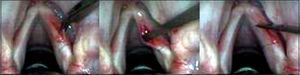 Performance of pediculated graft, positioning on subepithelial region and fixation with fibrin glue.