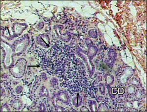 Presence of inflammatory focus amidst glandular tissue, indicated by the arrows (HE 100X).