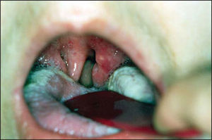 Oropharyngoscopy showing erythematous aspect of palatine tonsils, uvula edema and tongue monolyasis.