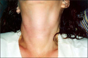 Neck inspection: note the goiter and lateral chain lymphoadenomegaly.