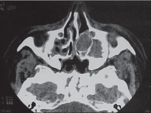 Paranasal sinuses CT scan (axial section) showing pansinusitis and mucopyocele of left middle concha.