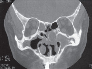 Paranasal sinuses CT scan (coronal section) showing mucopyocele located in the left middle concha.