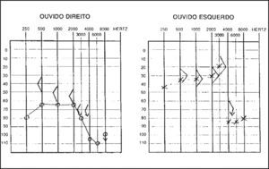 Audiometry with sensorineural hearing loss on the left and mixed loss on the right.