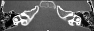 CT scan showing bilateral large vestibular aqueduct.