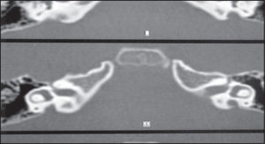 Audiometry showing bilateral mixed hearing loss.