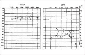 Audiometry showing mixed hearing loss on the left.