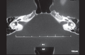 CT showing enlargement of left vestibular aqueduct.