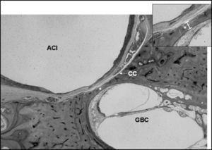 Smallest value of the measurement between the carotid canal and the basal turn (0.12 millimeters). CC = Carotid canal; ACI = Internal Carotid Artery, GBC = Cochlear Basal Turn. Histological section enlarged 20X.