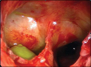 Fistula of right sphenoid sinus, drainage of CSF with fluorescein marker (green).