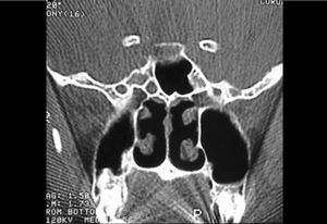 Computed Tomography of patient with CSF fistula in meningocele of sphenoid sinus.