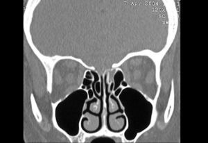 Computed Tomography of patient with CSF fistula in cribriform lamina during left ethmoidal sinusectomy.