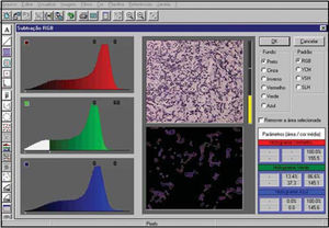 Image of software Imagelab 2000 informing the selected color (central quadrant to the left), original image (central upper quadrant), subtracted (central lower quadrant) and percentage of involved areas relative to the original image (right lower quadrant).
