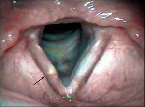 Bamboo nodule on the middle third of the right vocal fold (Arrow).