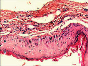Digitalized image of the lamina, cross section of a cholesteatoma, stained with Hematoxylin-Eosin. We can see three forming parts: A - perimatrix, B - matrix, C - cystic content.