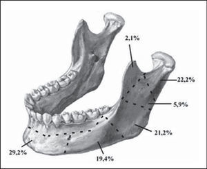 Schematic representation of the mandible fracture reductions according to location, HC-UFU, 1974-2002.