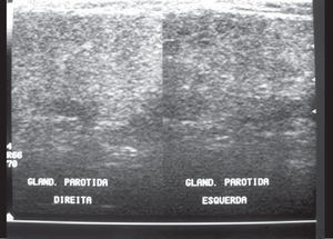 FDO Ultrasound (case 1). Initial examination. Left gland presented heterogeneous texture and the right gland was unaltered.