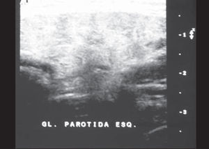 FDO Ultrasound (Case 1): Six years of progression, normal pattern.