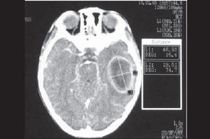 Extensive cerebral abscess on the left temporal lobe.