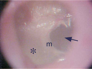 Otomicroscopy showing marked opacification of the posterior portion of the tympanic membrane (*), showing the anterior half with normal transparency (arrow). m – malleus manubrium.