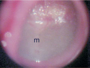 Otomicroscopy showing marked diffuse opacification of the tympanic membrane. m – malleus manubrium.