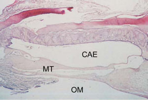 Axial section stained with HE, 10 X, of the tympanic membrane (MT) with tympanosclerosis phase 3. CAE – external auditory canal; OM – middle ear.