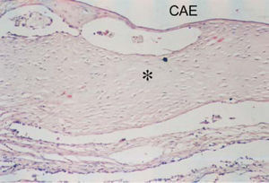Detail of Figure 1: Note the sparse fibroblasts, involved by hyaline collagen (*). CAE – external auditory canal.
