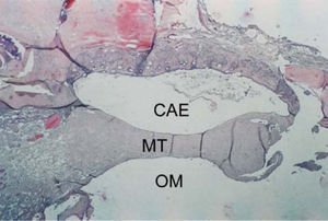 Axial section stained with HE, 10 X, of tympanic membrane (MT) with tympanosclerosis phase 4. CAE – external auditory canal.; OM – middle ear.