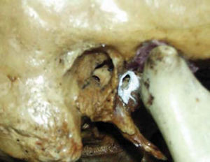 Foramen of Huschke evidenced with barium sulfate.