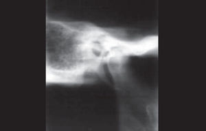 Corrected lateral CTs can - TMJ CT scan sections - section B with barium sulfate.